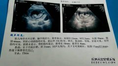 12周nt颈透明3.4毫米
